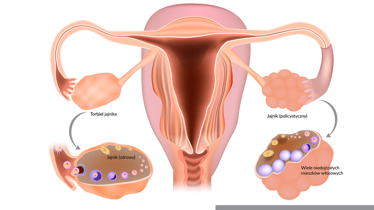 The Role of Eplerenone in Treating Polycystic Ovary Syndrome (PCOS)